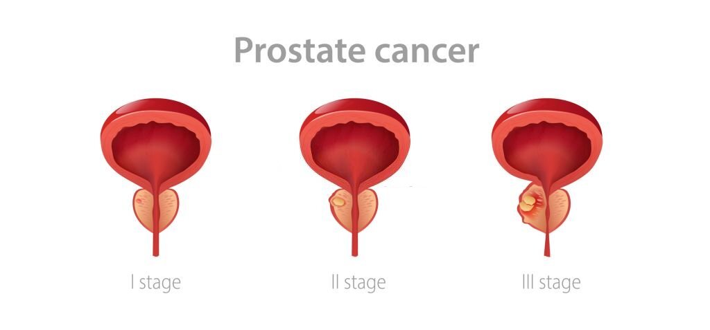 prostate Cancer Stages demonstration